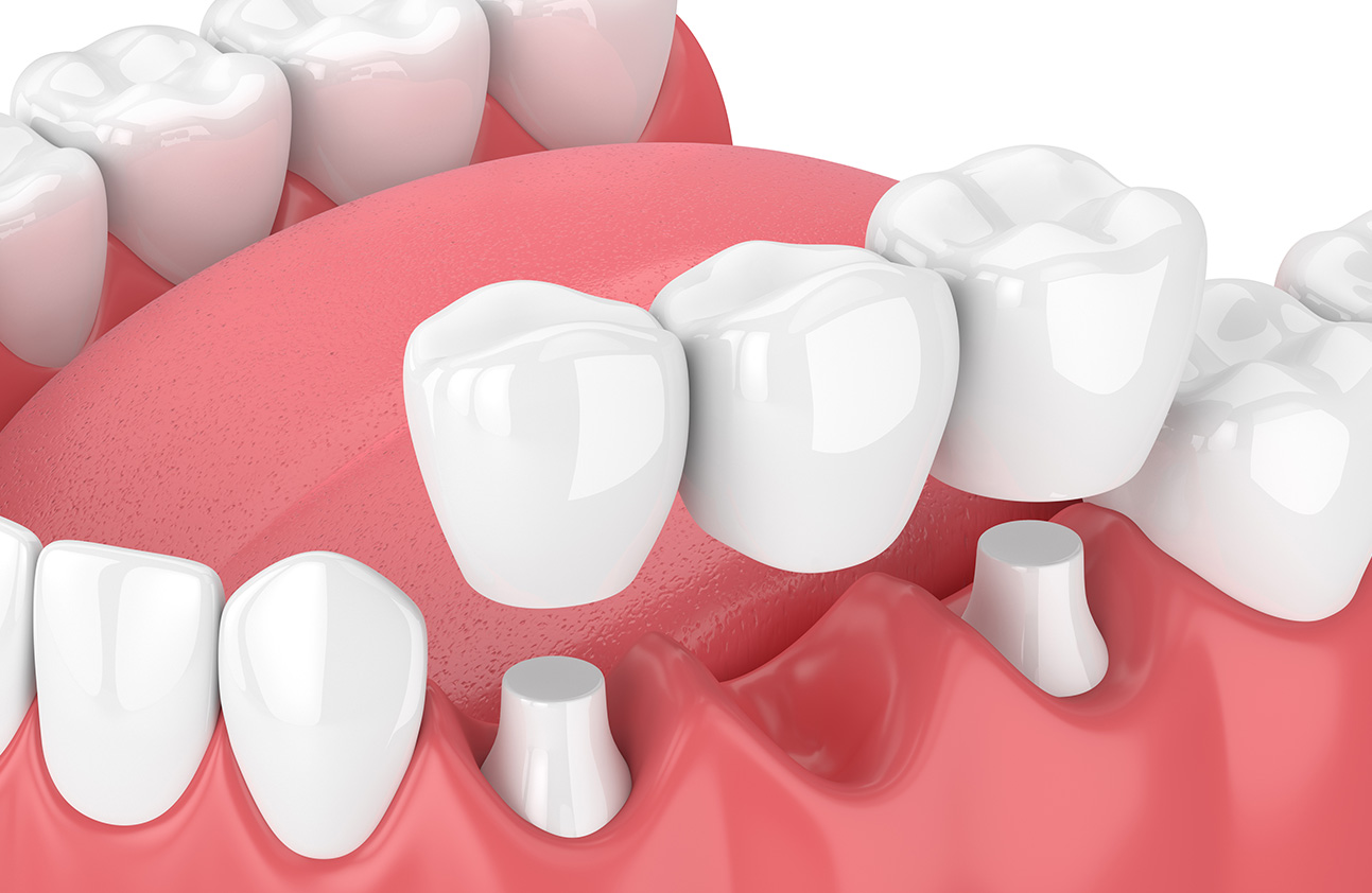 dental bridge in Portadown Northern Ireland