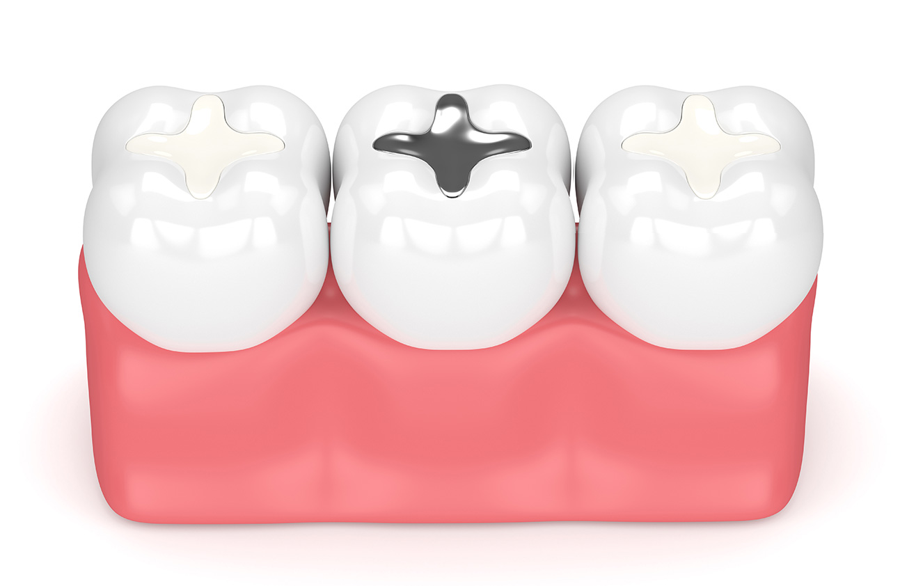 Dental fillings in Portadown Northern Ireland